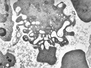 M,24y. | bone marrow - haemolytic anemia(ropalocyte - picturesque reticulocyte)